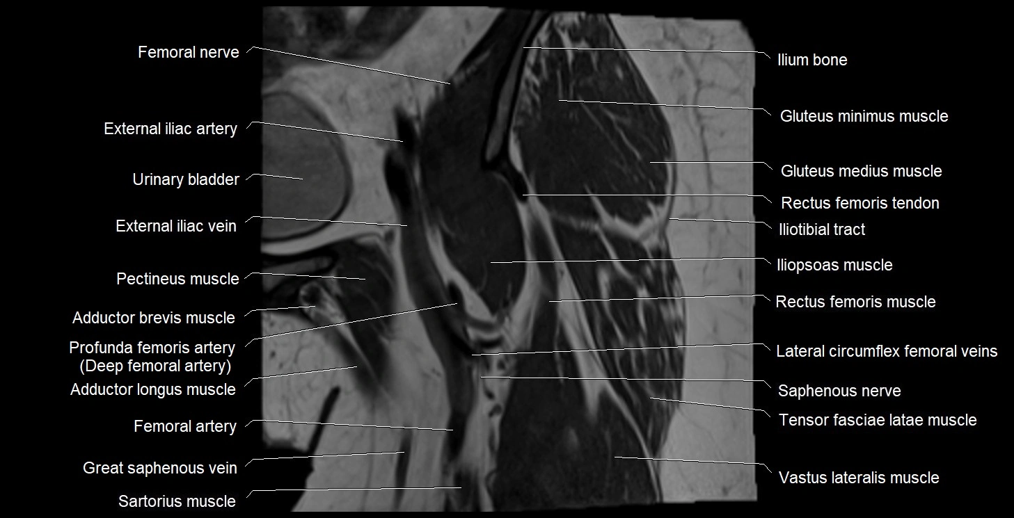 MRI Hip 3T coronal cross sectional anatomy image 14.webp